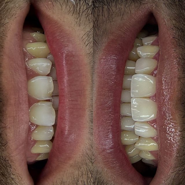 Resultado de tratamiento dental