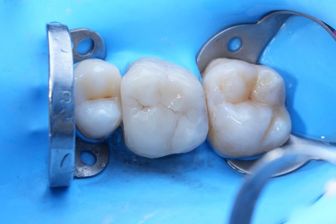 Resultado de tratamiento dental