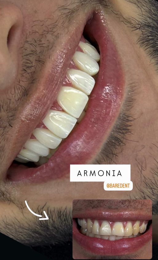 Resultado de tratamiento dental