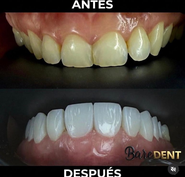 Resultado de tratamiento dental