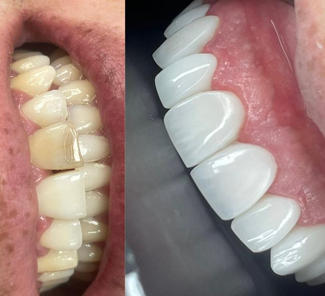 Resultado de tratamiento dental